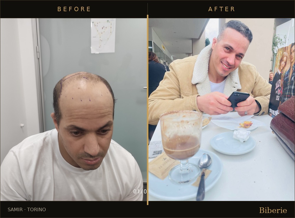 Hair transplant before and after — Samir, Torino