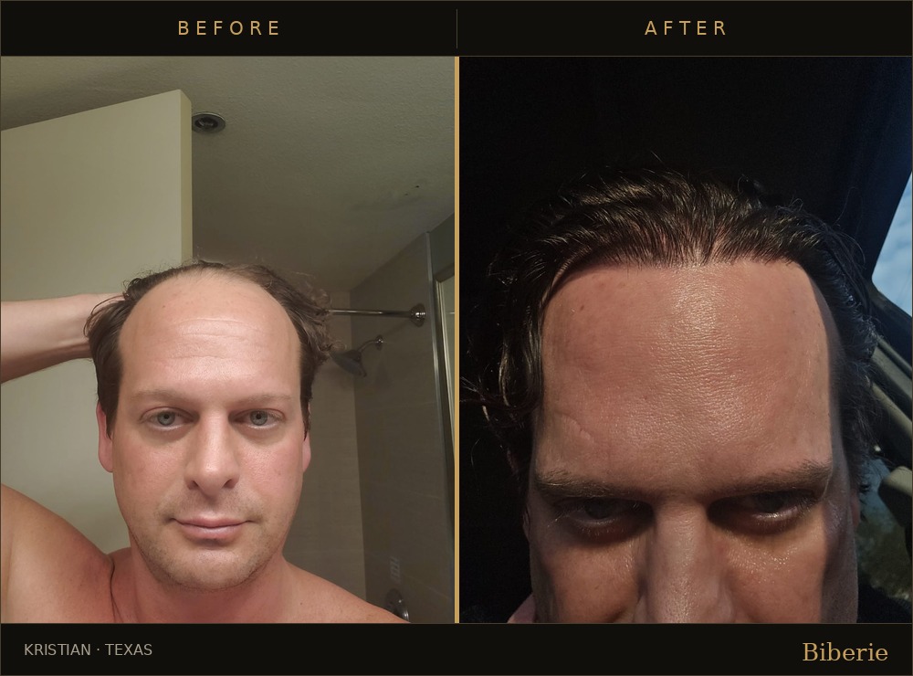Hair transplant graft placement close-up