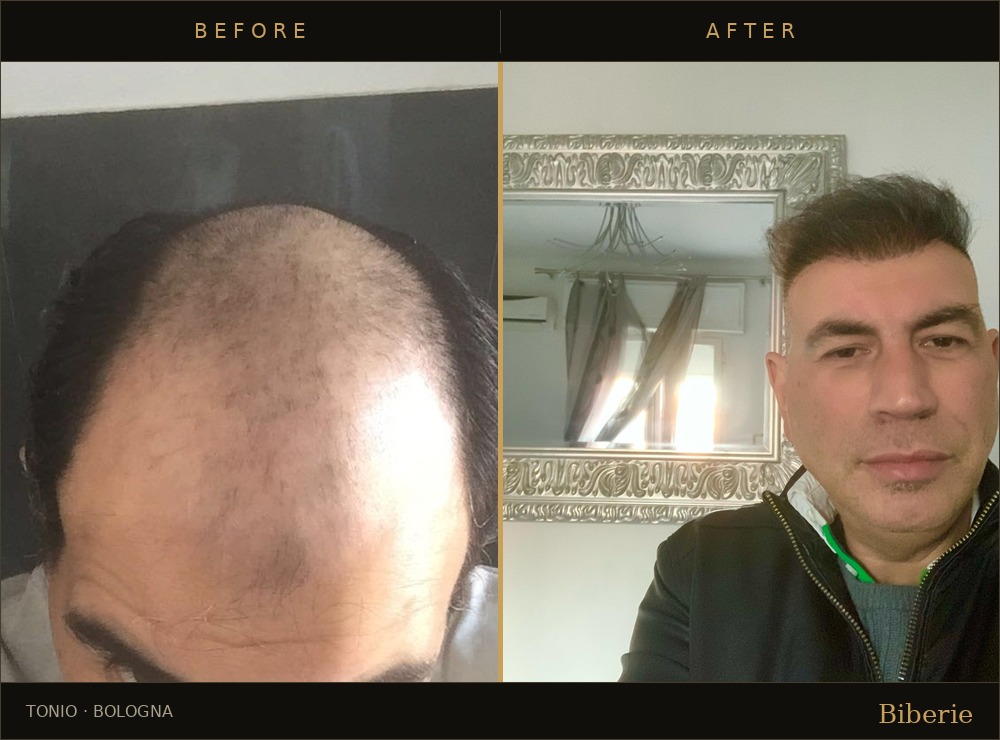 Rhinoplasty patient post-operative consultation