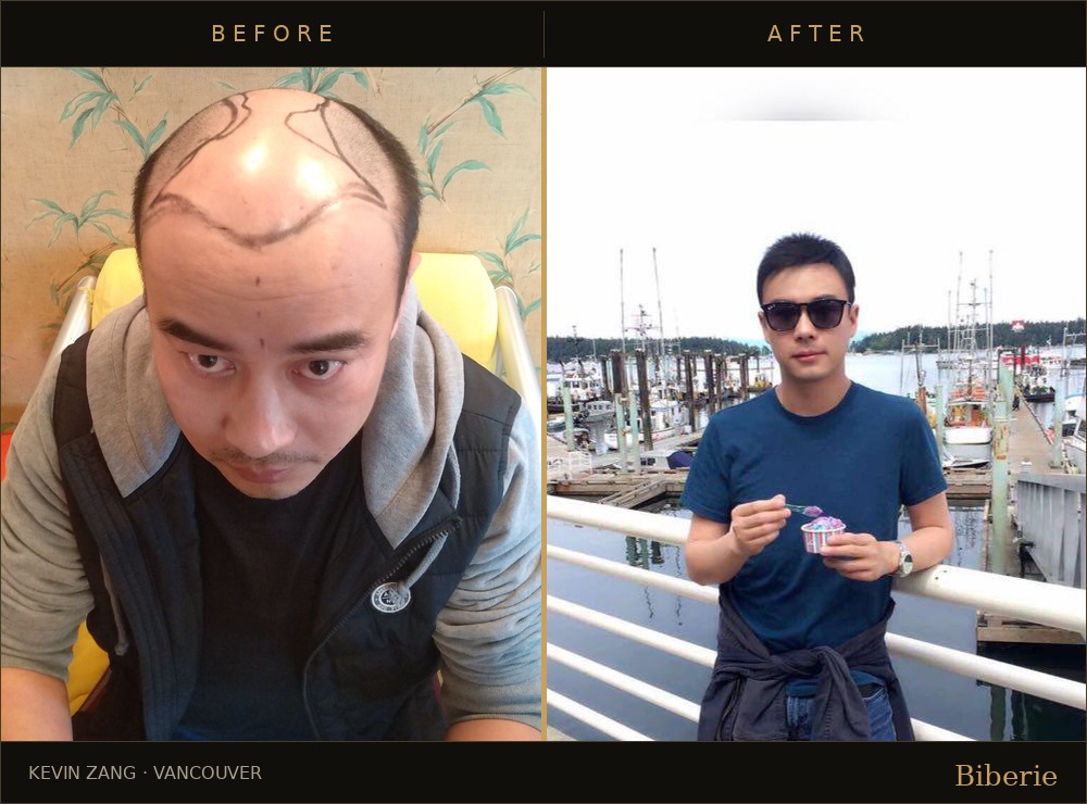 Hair transplant before and after — Kevin Zang, Vancouver