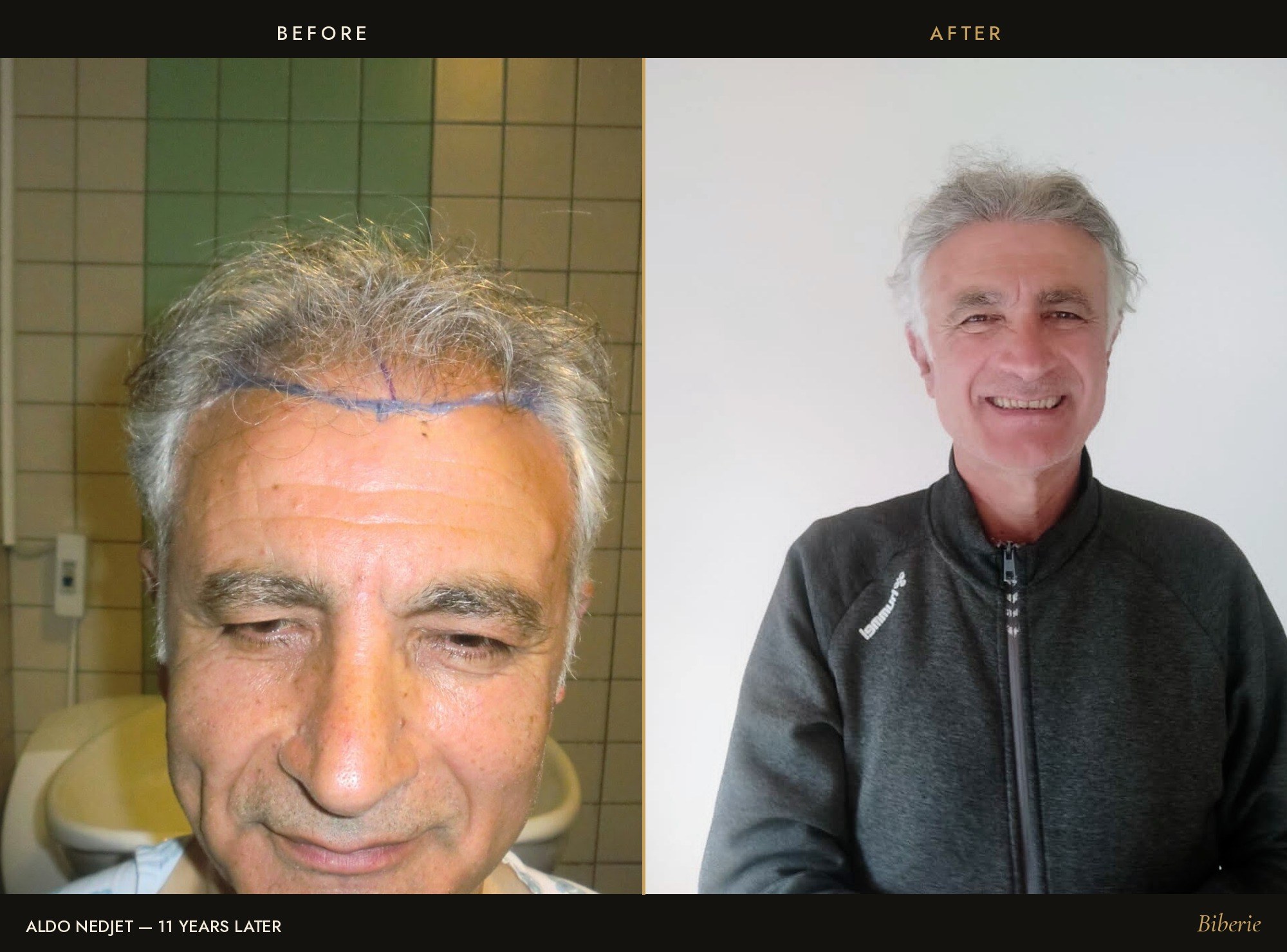 Aldo Nedjet, before and after his own hair transplant, 11 years later