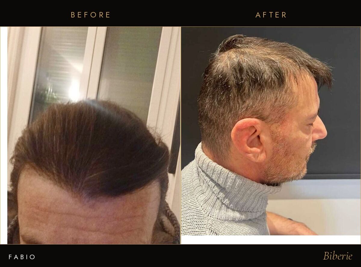 Fabio Quirino, before and after his hair transplant at Biberie Clinic
