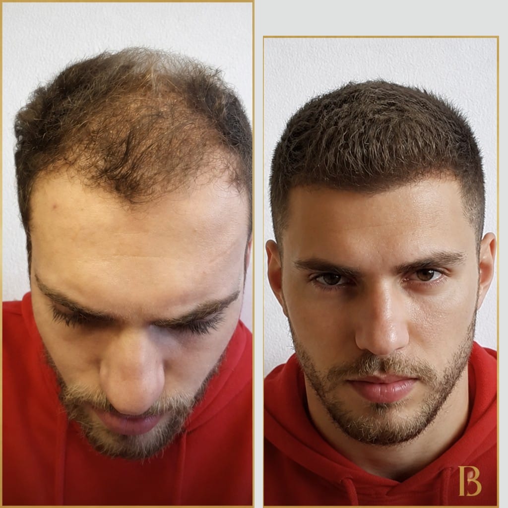 Haartransplantation — gelebtes Ergebnis