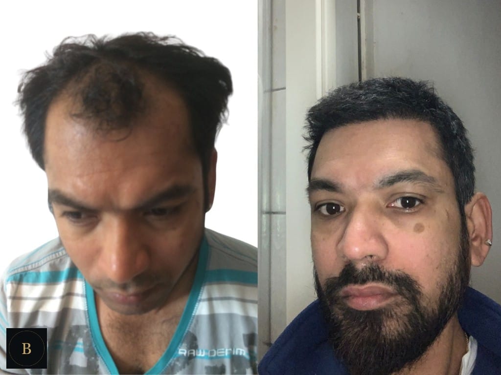 Haartransplantation — gelebtes Ergebnis