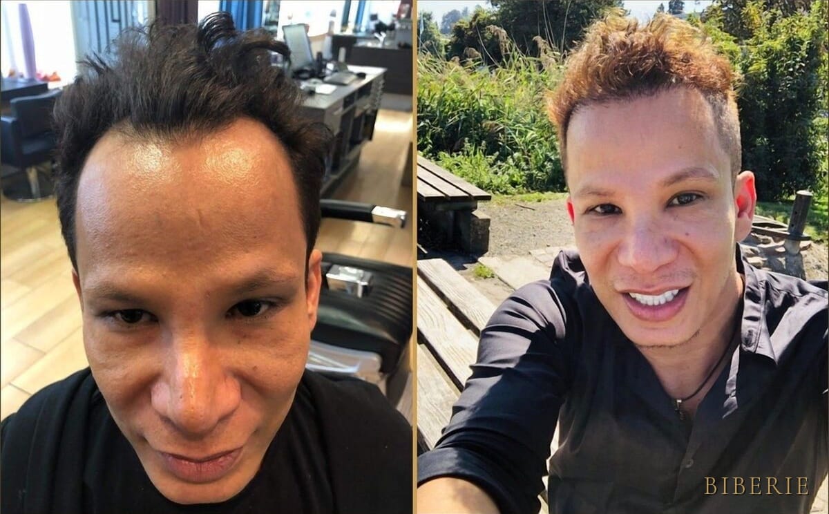 Haartransplantation — gelebtes Ergebnis