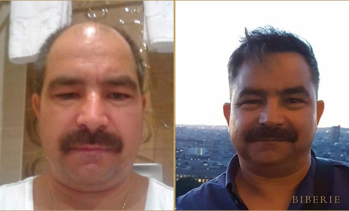 Haartransplantation — gelebtes Ergebnis