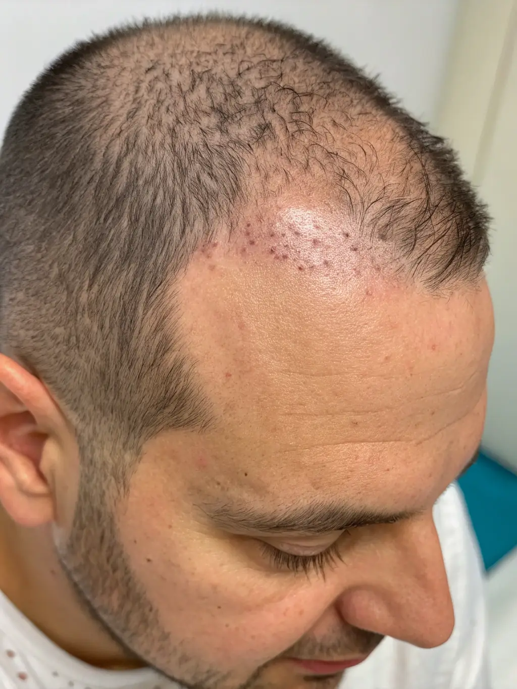 A close-up before-and-after photo showcasing a successful hair transplantation procedure at Biberie, highlighting the restored hairline and natural hair growth.