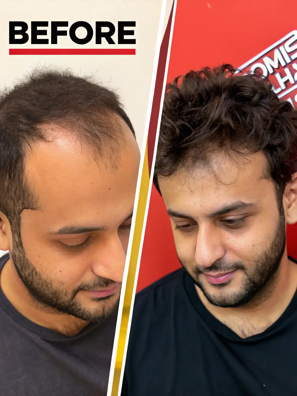 A before-and-after image demonstrating the successful results of a hair transplant at Biberie, highlighting natural hair growth.