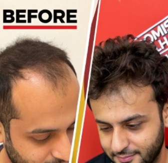 direct_hair_implantation_v2